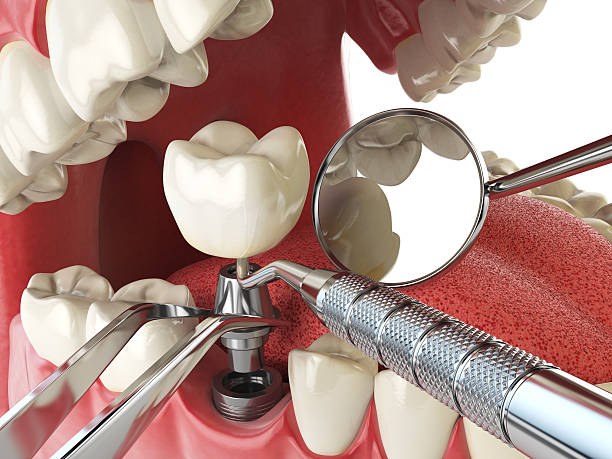 Best Emergency Tooth Extraction in Palmdale, CA